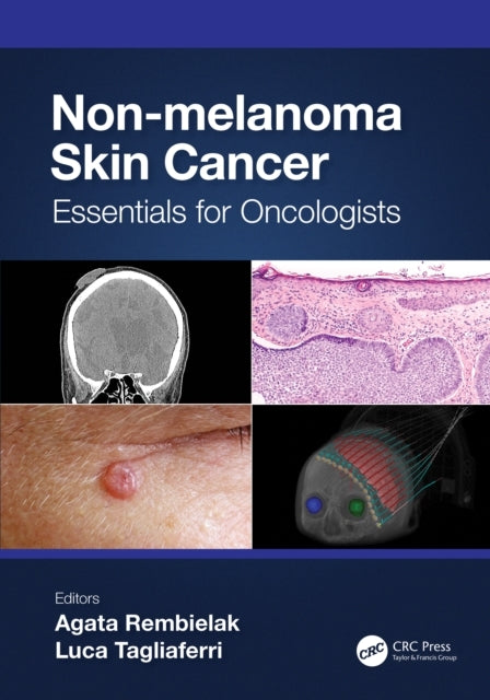 Non-Melanoma Skin Cancer Essentials For Oncologists