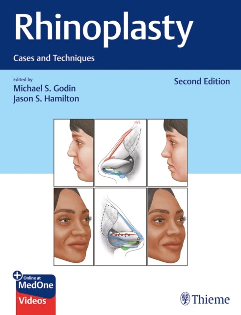 Rhinoplastycases And Techniques