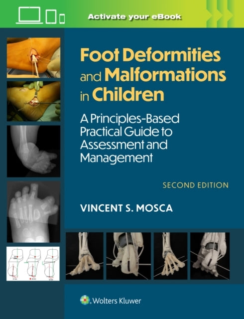 Foot Deformities and Malformations In Childrena Principles-B